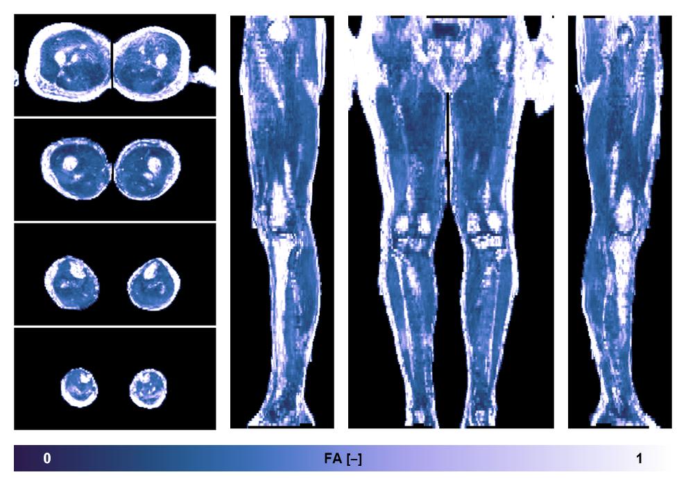 IVIM corrected whole leg muscle fractional anisotropy obtained from diffusion tensor imaging.